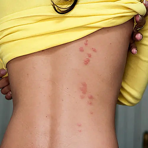 Ágyi poloska csípései egy ember hátán