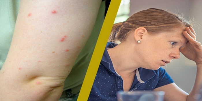 Ágyi poloska csípések és lelki terhei